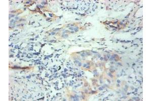 Immunohistochemical of paraffin-embedded human breast cancer tissue using ABIN7152614 at dilution of 1:200 (FABP3 Antikörper)