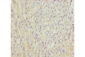 Immunohistochemistry of paraffin-embedded human liver cancer using ABIN7149264 at dilution of 1:100 (CYP3A4 Antikörper  (AA 244-503))