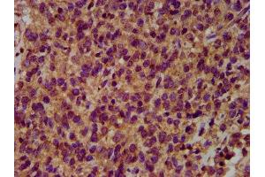 IHC image of ABIN7151037 diluted at 1:500 and staining in paraffin-embedded human glioma performed on a Leica BondTM system. (HECW2 Antikörper  (AA 495-641))