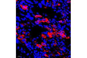 Immunofluorescent analysis of paraffin embedded human ovarian cancer using CK6 (ABIN7074423) at dilution of 1: 2000 (Keratin 6 Antikörper)