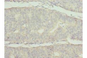 Immunohistochemistry of paraffin-embedded human endometrial cancer using ABIN7174024 at dilution of 1:100 (FRK Antikörper  (AA 1-220))