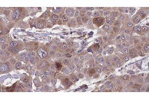ABIN6276422 at 1/100 staining Human liver cancer tissue by IHC-P. (CEACAM5 Antikörper  (Internal Region))