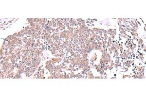 Immunohistochemistry of paraffin-embedded Human lung cancer tissue using JDP2 Polyclonal Antibody at dilution of 1:40(x200) (JDP2 Antikörper)