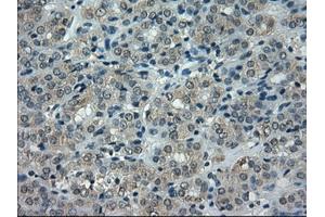 Immunohistochemical staining of paraffin-embedded Carcinoma of thyroid tissue using anti-CRYABmouse monoclonal antibody. (CRYAB Antikörper)