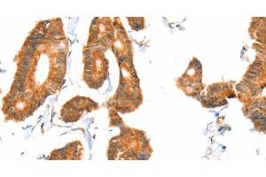 Immunohistochemistry of paraffin-embedded Human colon cancer tissue using ACOX1 Polyclonal Antibody at dilution 1:40 (ACOX1 Antikörper)