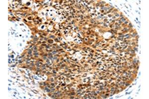 The image on the left is immunohistochemistry of paraffin-embedded Human esophagus cancer tissue using ABIN7191028(HUNK Antibody) at dilution 1/35, on the right is treated with synthetic peptide. (HUNK Antikörper)