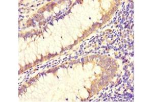 Immunohistochemistry of paraffin-embedded human colon cancer using ABIN7150029 at dilution of 1:100 (DAAM2 Antikörper  (AA 1-101))