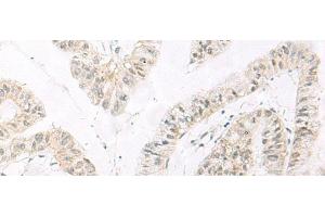 Immunohistochemistry of paraffin-embedded Human liver cancer tissue using HABP4 Polyclonal Antibody at dilution of 1:60(x200) (HABP4 Antikörper)