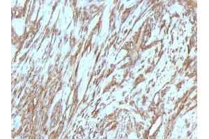 Formalin-fixed, paraffin-embedded human Leiomyosarcoma stained with Muscle Specific Actin Mouse Monoclonal Antibody (MSA/953). (ACTA1/ACTA2A/ACTG2 Antikörper)