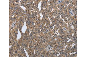 Immunohistochemistry of Human lung cancer using PDIA2 Polyclonal Antibody at dilution of 1:50 (PDIA2 Antikörper)