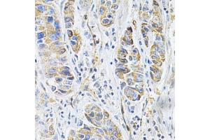 Immunohistochemistry of paraffin-embedded human liver cancer using VAPB Antibody (ABIN5973099) at dilution of 1/200 (40x lens).