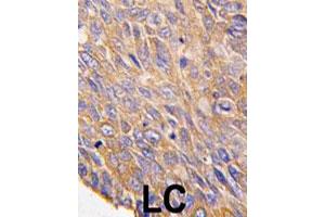 Formalin-fixed and paraffin-embedded human lung carcinoma tissue reacted with TOB2 polyclonal antibody  , which was peroxidase-conjugated to the secondary antibody, followed by DAB staining. (TOB2 Antikörper  (N-Term))