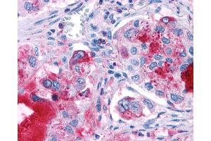 Anti-GPR82 antibody IHC of human Lung, Adenocarcinoma. (GPR82 Antikörper  (Cytoplasmic Domain))