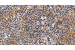 Immunohistochemistry of paraffin-embedded Human liver cancer tissue using ARRB1 Polyclonal Antibody at dilution 1:50 (beta Arrestin 1 Antikörper)
