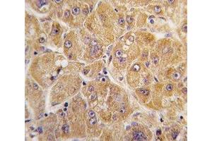 IHC analysis of FFPE human hepatocarcinoma tissue stained with ALDH1A1 antibody (ALDH1A1 Antikörper  (AA 302-331))