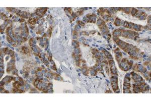 ABIN6267160 at 1/100 staining Human thyroid cancer tissue by IHC-P.