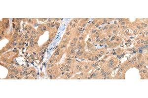 Immunohistochemistry of paraffin-embedded Human thyroid cancer tissue using CA7 Polyclonal Antibody at dilution of 1:50(x200) (CA7 Antikörper)