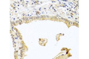 Immunohistochemistry of paraffin-embedded Human lung cancer using PRKCA Polyclonal Antibody at dilution of 1:100 (40x lens). (PKC alpha Antikörper)