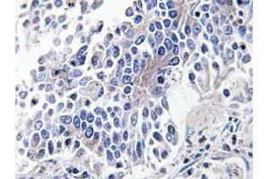 Immunohistochemical analysis of paraffin-embedded human lung cancer tissue using MAPK8IP3 polyclonal antibody . (JIP3 Antikörper)