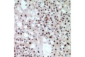 Immunohistochemical analysis of CHD4 staining in human liver cancer formalin fixed paraffin embedded tissue section.