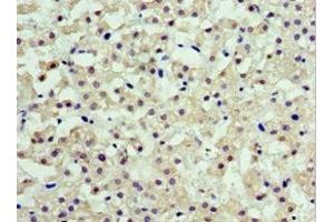 Immunohistochemistry of paraffin-embedded human liver cancer using ABIN7143462 at dilution of 1:100 (ARFGAP3 Antikörper  (AA 217-516))