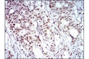 Immunohistochemical analysis of paraffin-embedded human cervical cancer tissues using MAPK7 mouse mAb with DAB staining. (MAPK7 Antikörper  (AA 411-556))
