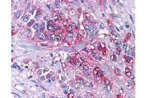 Anti-P2RY4 / P2Y4 antibody IHC of human Pancreas, Carcinoma. (P2RY4 Antikörper  (Cytoplasmic Domain))
