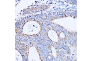 Immunohistochemistry of paraffin-embedded human colon carcinoma using MT-ND3 antibody (ABIN7268601) at dilution of 1:100 (40x lens). (MT-ND3 Antikörper)