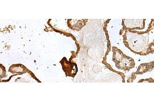 Immunohistochemistry of paraffin-embedded Human thyroid cancer tissue using UBE2Z Polyclonal Antibody at dilution of 1:35(x200) (UBE2Z Antikörper)