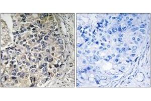 Immunohistochemistry analysis of paraffin-embedded human prostate carcinoma tissue, using CMC1 Antibody. (CMC1 Antikörper  (AA 391-440))