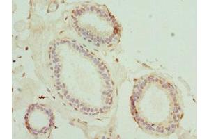 Immunohistochemistry of paraffin-embedded human breast cancer using ABIN7159178 at dilution of 1:100 (MATK Antikörper  (AA 393-507))