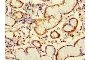 Immunohistochemistry of paraffin-embedded human gastric cancer using ABIN7145670 at dilution of 1:100 (C6orf89 Antikörper  (AA 120-320))