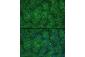 Immunofluorescence analysis of human liver cancer using CBS Rabbit pAb (ABIN3021958, ABIN3021959, ABIN3021960 and ABIN6218521) at dilution of 1:100 (40x lens). (CBS Antikörper  (AA 252-551))