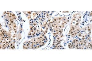Immunohistochemistry of paraffin-embedded Human lung cancer tissue using MAGEA6 Polyclonal Antibody at dilution 1:120 (MAGEA6 Antikörper)