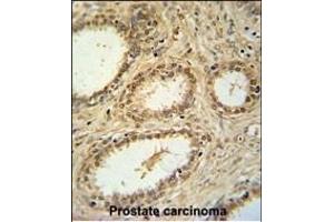 SNRNP40 Antibody (Center) (ABIN651465 and ABIN2840256) immunohistochemistry analysis in formalin fixed and paraffin embedded human prostate carcinoma followed by peroxidase conjugation of the secondary antibody and DAB staining.