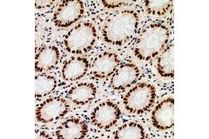Immunohistochemical analysis of ZNF839 staining in human colon cancer formalin fixed paraffin embedded tissue section. (ZNF839 Antikörper)