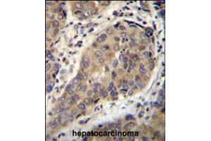 WTIP Antibody immunohistochemistry analysis in formalin fixed and paraffin embedded human hepatocarcinoma followed by peroxidase conjugation of the secondary antibody and DAB staining. (WTIP Antikörper  (AA 243-271))
