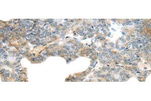Immunohistochemistry of paraffin-embedded Human thyroid cancer using SERPINB11 Polyclonal Antibody at dilution of 1/20