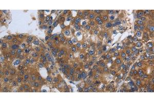 Immunohistochemistry of paraffin-embedded Human liver cancer using SOCS1 Polyclonal Antibody at dilution of 1:90 (SOCS1 Antikörper)