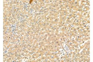 ABIN6262550 and ABIN6277073 at 1/100 staining Human liver cancer and adjacent normal tissues by IHC-P.