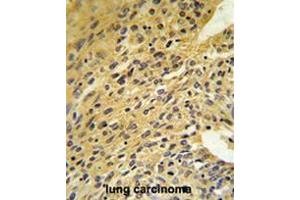 COQ5 Antibody (Center) IHC analysis in formalin fixed and paraffin embedded human lung carcinoma followed by peroxidase conjugation of the secondary antibody and DAB staining. (COQ5 Antikörper  (Middle Region))