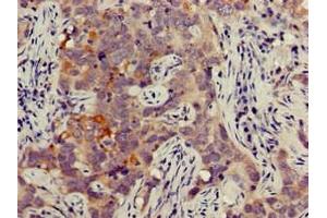 Immunohistochemistry of paraffin-embedded human pancreatic cancer using ABIN7165664 at dilution of 1:100 (JAG1 Antikörper  (AA 809-1046))