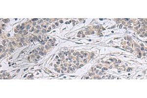 Immunohistochemistry of paraffin-embedded Human colorectal cancer tissue using PPM1K Polyclonal Antibody at dilution of 1:55(x200) (PPM1K Antikörper)
