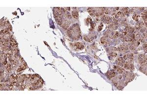 ABIN6273281 at 1/100 staining Human pancreas cancer tissue by IHC-P. (OXA1L Antikörper  (C-Term))
