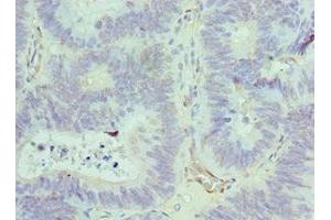 Immunohistochemistry of paraffin-embedded human colon cancer using ABIN7143847 at dilution of 1:100 (ACTR1A Antikörper  (AA 187-376))