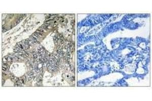 Immunohistochemistry analysis of paraffin-embedded human colon carcinoma tissue using GUF1 antibody. (GUF1 Antikörper)