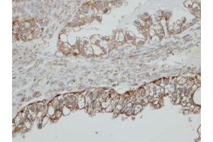 IHC-P Image Immunohistochemical analysis of paraffin-embedded human ovarian cancer, using HSD17B4, antibody at 1:500 dilution.