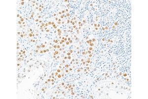 Immunohistochemistry (IHC) image for anti-MutL Homolog 1 (MLH1) (AA 450-500) antibody (ABIN7455102) (Rekombinanter MLH1 Antikörper  (AA 450-500))