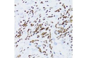 Immunohistochemistry of paraffin-embedded human gastric cancer using NFKB2 Antibody. (NFKB2 Antikörper  (AA 690-899))