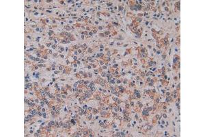 Used in DAB staining on fromalin fixed paraffin- embedded prostate gland cancer tissue (MFAP2 Antikörper  (AA 6-162))